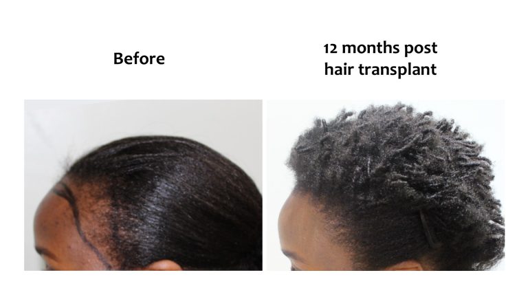 Hairhub patient before and after, hairline, 12 months after fue