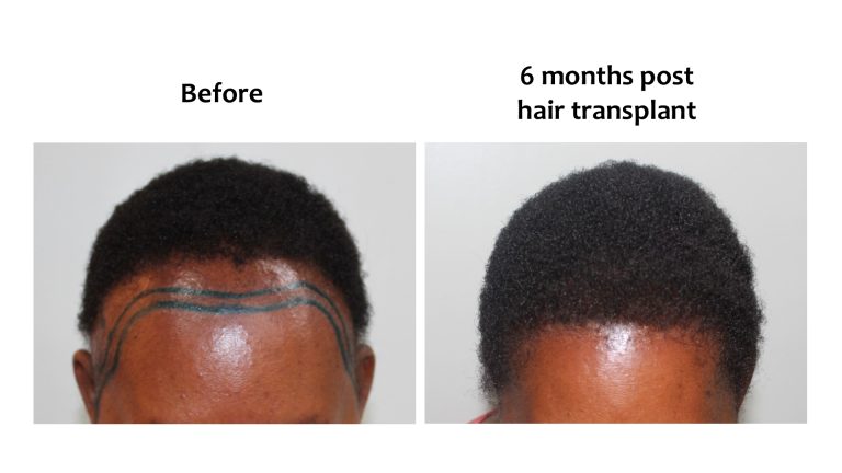 Graft calculator, Hairhub patient photo