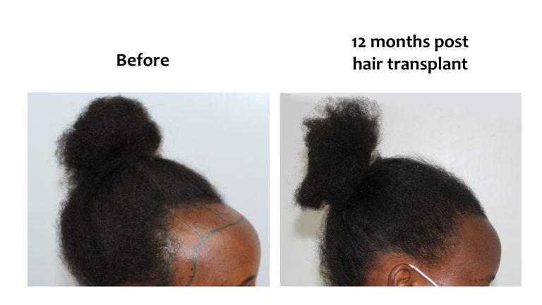 Hairhub patient before and after, hairline, 12 months after fue