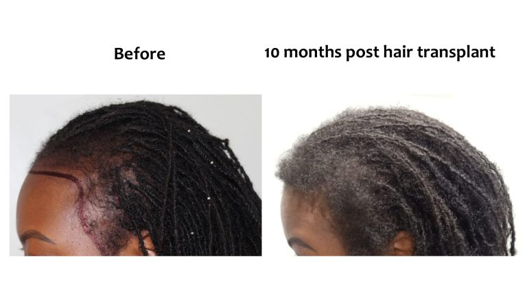Hairhub patient before and after, hairline after fue