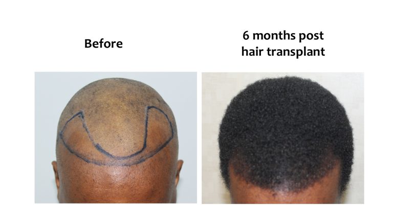Hairhub patient before and after, crown and top, 6 months after fue