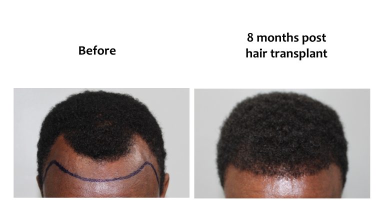 Hairline result for male pattern hair loss at Hairhub