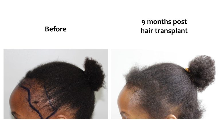 Hairhub patient before and after, hairline, 9 months after fue