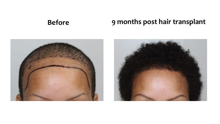 Receding hairline, Hairhub patient photo