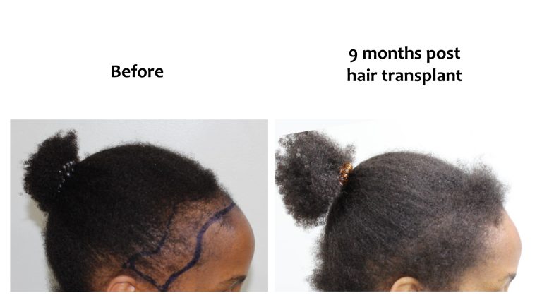 Hairhub patient before and after, hairline, 9 months after fue
