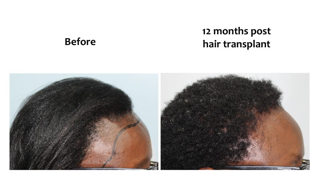 Before and after: Hairline restoration, woman, 12 months after, Hairhub patient, Nairobi
