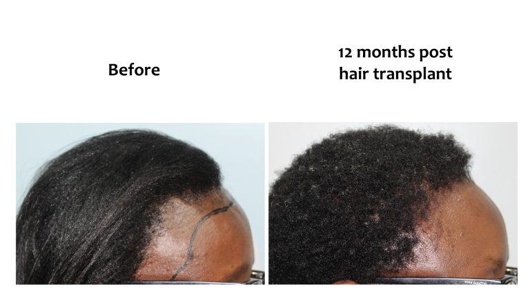 Hair transplant for women, Hairhub patient photo