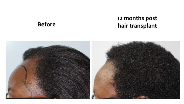 Thinning edges, Hairhub patient photo