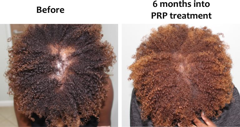 Thinning in women, Hairhub patient photo