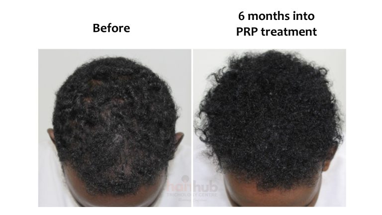 PRP and GFC, Hairhub patient photo