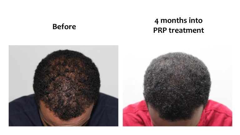 Result at Hairhub where Minoxidil is combined with PRP