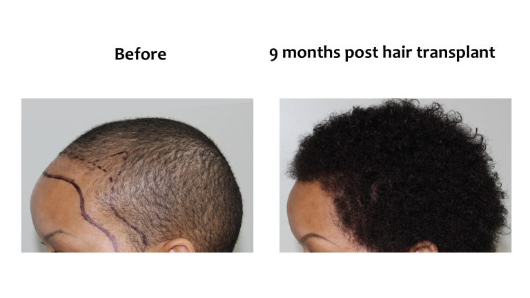 Male pattern baldness, Hairhub patient photo