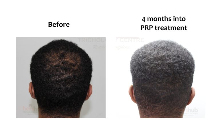 Minoxidil and Finasteride, Hairhub patient photo