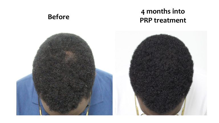 Hairhub patient before and after, 4 months into prp