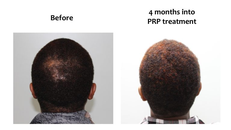 Hairhub patient before and after, 4 months into prp