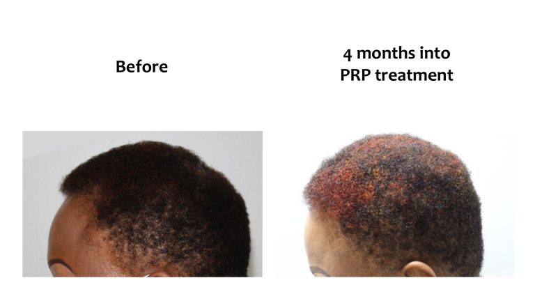 Hairhub patient before and after, 4 months into prp