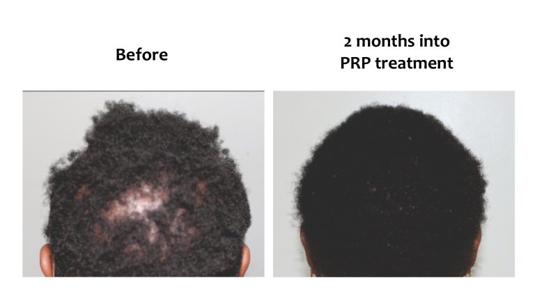 Hairhub patient before and after, 2 months into prp