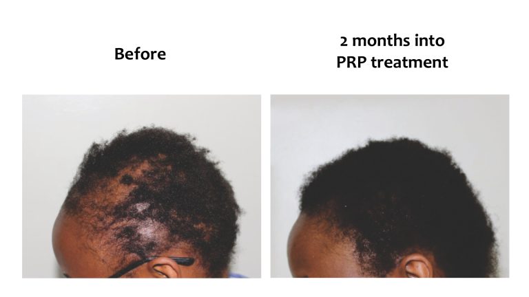 Hairhub patient before and after, 2 months into prp