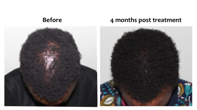 Sudden shedding, Hairhub patient photo