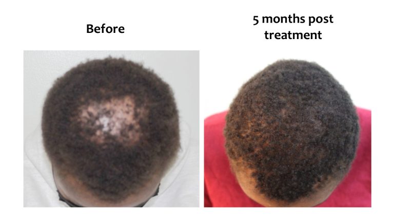 After pregnancy, Hairhub patient photo