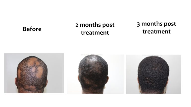 Alopecia areata, Hairhub patient photo