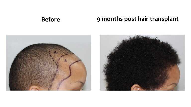 Hairhub patient before and after, crown, 9 months after fue