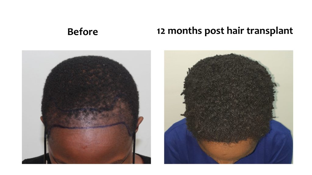 Before and after: FUE transplant, man, 12 months after, Hairhub patient, Nairobi
