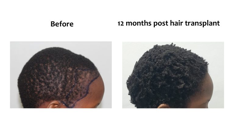 Before and after a hair transplant at Hairhub Nairobi