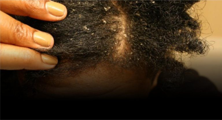 Dandruff, Hairhub patient photo