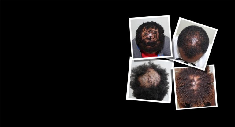 Traction alopecia and CCCA, Hairhub patient photo